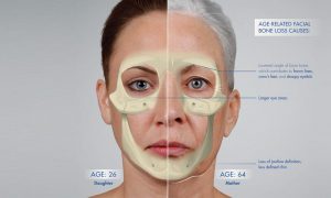 تحلیل رفتن استخوان ها و ایجاد افتادگی در پوست صورت