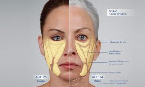 تحلیل رفتن چربی زیر پوستی و ایجاد افتادگی در پوست صورت