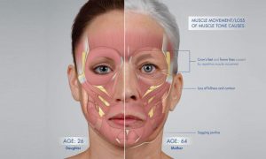 تحلیل رفتن عضلات و ایجاد افتادگی در پوست صورت