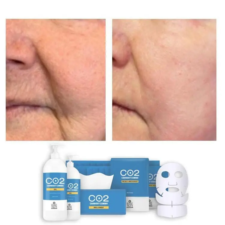 تاثیر ژل کربوکسی ریب اسکین