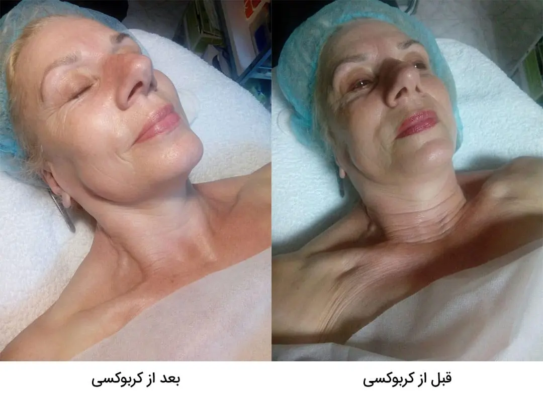 قبل و بعد استفاده از کربوکسی