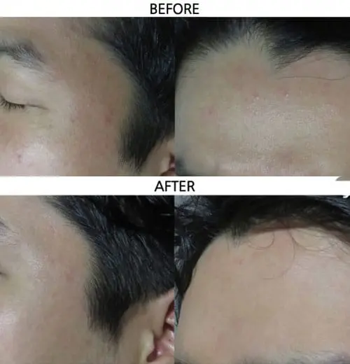 تاثیر ژل کربوکسی ریب اسکین