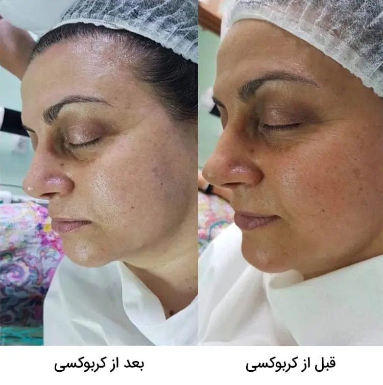 قبل و بعد استفاده از کربوکسی