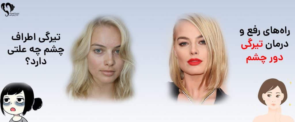 تیرگی دور چشم