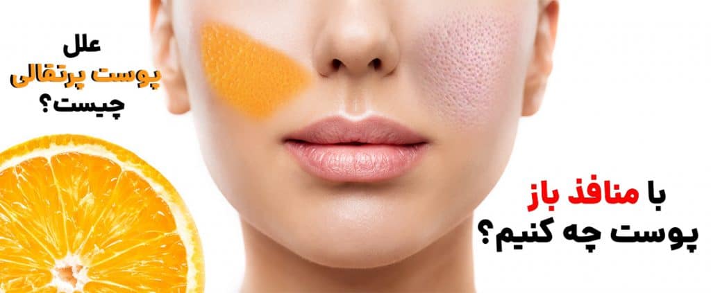با پوست پرتقالی و منافذ باز چه کنیم