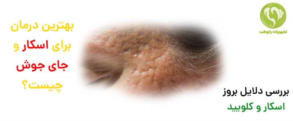 درمان اسکار و جای جوش