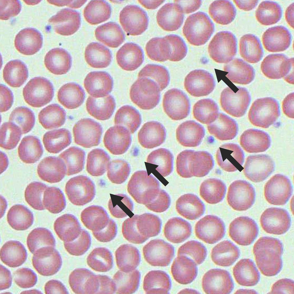 پلاکت در یک نمونه خون