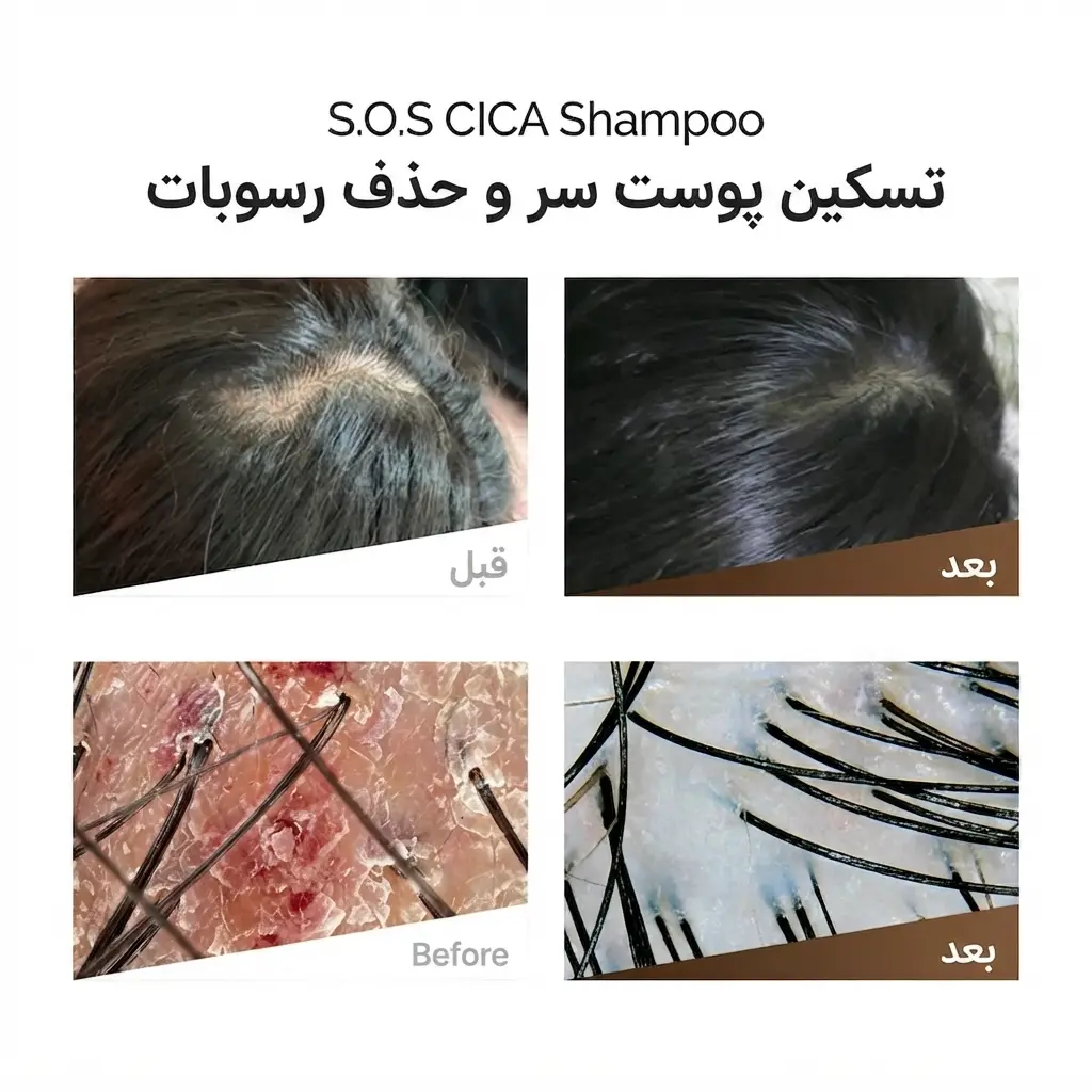 قبل و بعد از استفاده از شامپو سیکا روتونیکس