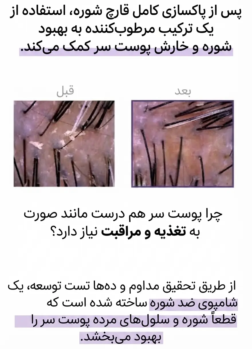شامپو ضد شوره روتونیکس