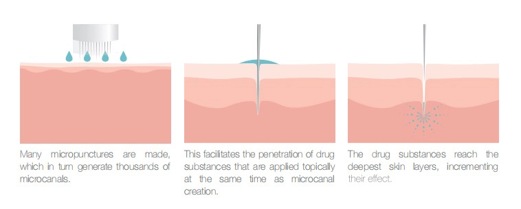 فرایند اثر درمارولر (میکرونیدل)